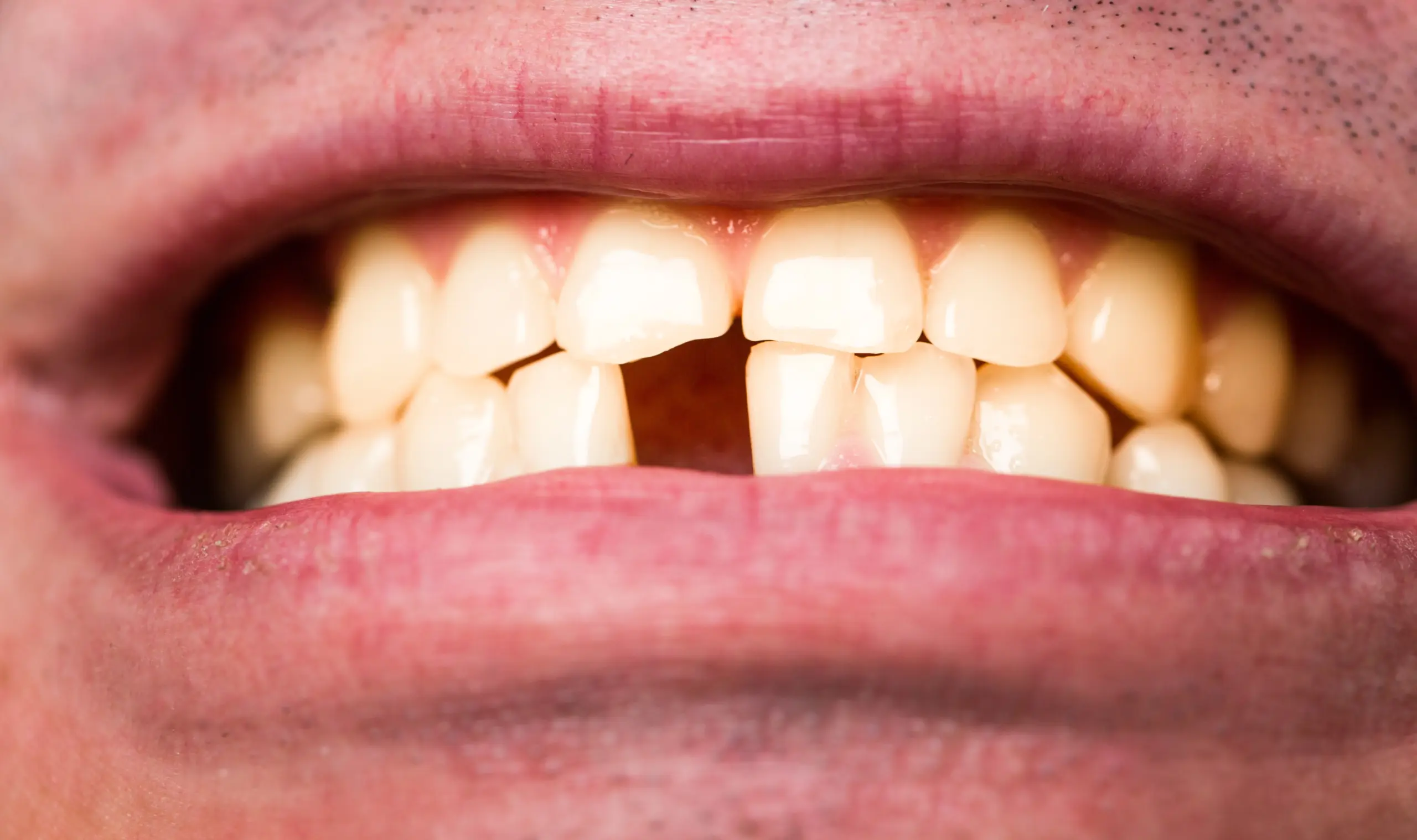 causes of tooth decay