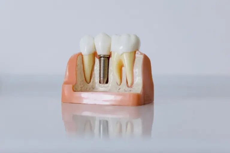 Close up of an implant model in a jaw segment, showing parts and lab work relevant to implant costs in the UK.