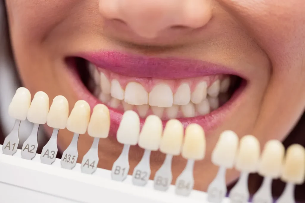 Photo showing what crowns for teeth look like during a dentist shade match.