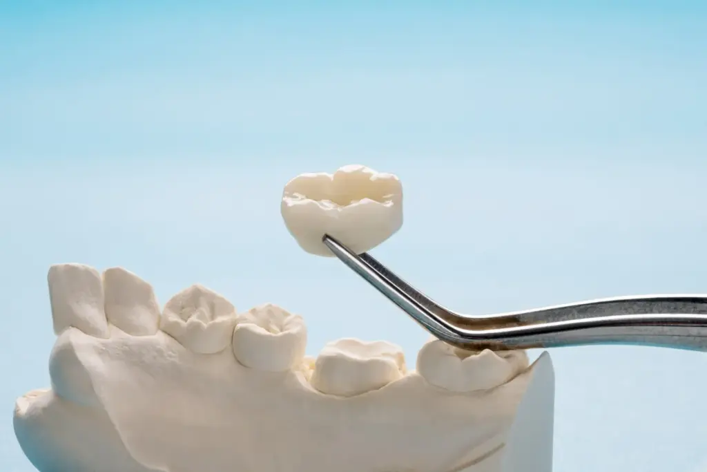 Lab example showing what crowns for teeth are made from and when each material suits.