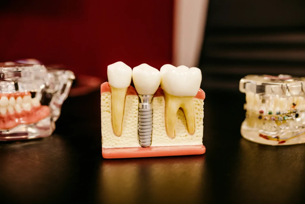 Close up model showing an endosteal dental implant with crown beside natural teeth.